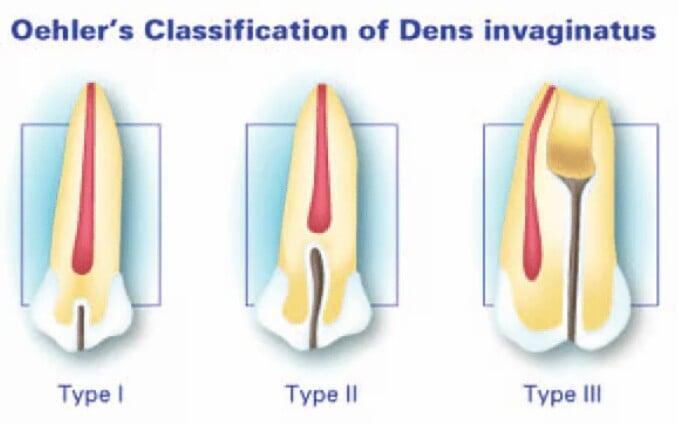 Unexplained Tooth Pain? How CBCT Can Detect Hidden Dental Pathology