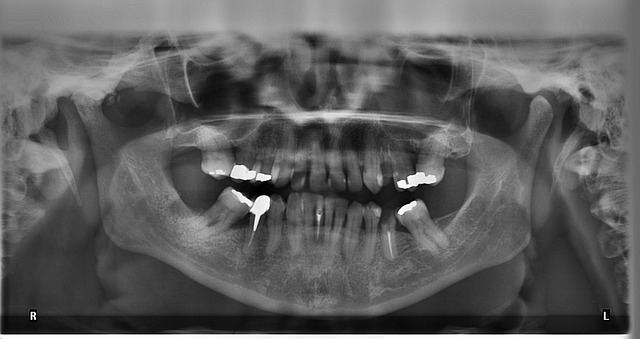 How High-Quality OPG Imaging Helps Dentists Plan Better Treatments